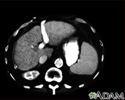 Liver cirrhosis - CT scan
