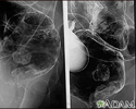 Rectal cancer - X-ray