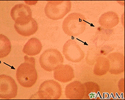 Malaria, photomicrograph of cellular parasites