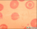 Red blood cells, target cells