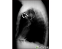 Pulmonary mass - side view chest X-ray