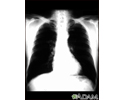 Bronchial cancer - chest X-ray