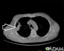 Lung mass, right lung - CT scan