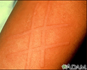 Dermatographism on the arm