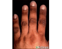 Acanthosis nigricans on the hand