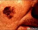 Skin cancer, close-up of lentigo maligna melanoma
