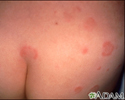 Hives (urticaria) on the back and buttocks