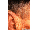 Actinic keratosis - ear