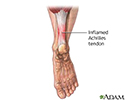 Inflamed Achilles tendon