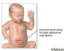 Infant abdominal hernia (gastroschisis)