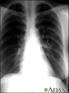 Coccidioidomycosis - chest X-ray