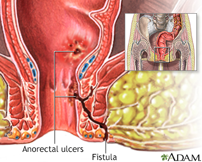 Anorectal fistulas