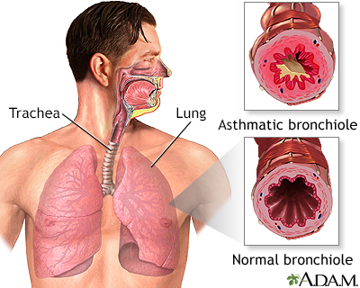 Asthmatic bronchiole and normal bronchiole