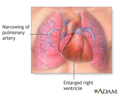 Primary pulmonary hypertension