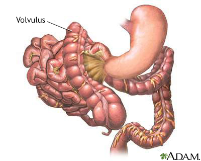 Volvulus