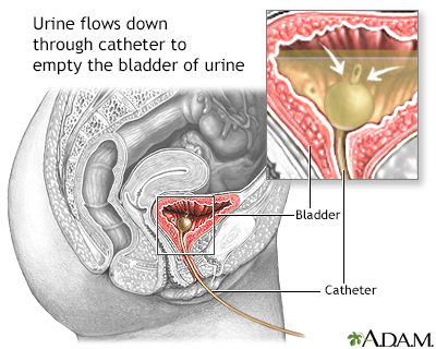 Bladder catheterization - female