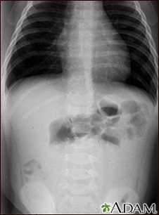 Intussusception - X-ray