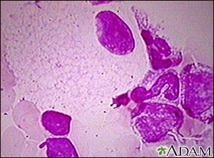 Niemann-Pick foamy cells