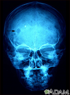 Eosinophilic granuloma - X-ray of the skull