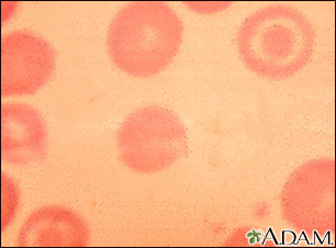 Red blood cells, target cells