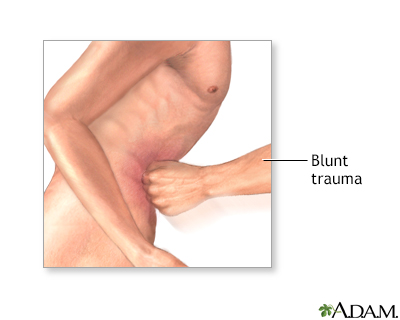 <strong>Diagnostic peritoneal lavage - series</strong><p>Blunt trauma to the abdomen is a major component of traumatic injury and can be deadly. Blunt trauma can occur during falls, motor vehicle accidents, or severe blows to the abdomen.</p>