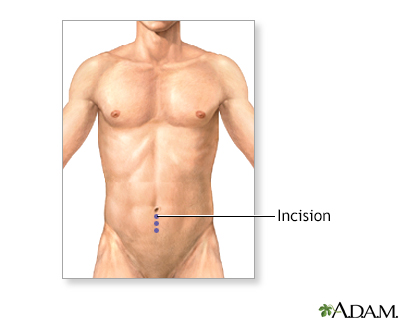 <strong>Incision</strong><p>Often it is difficult to determine if an intra-abdominal injury has occurred in a blunt trauma victim. In many cases, the decision about when to perform an exploratory laparotomy surgery is not straightforward. One procedure used to determine whether blunt trauma victims require surgery is diagnostic peritoneal lavage (DPL). DPL helps determine whether an intra-abdominal injury exists and whether surgery is required. Using local anesthesia, the surgeon makes a small incision in the abdomen just below the umbilicus.</p>