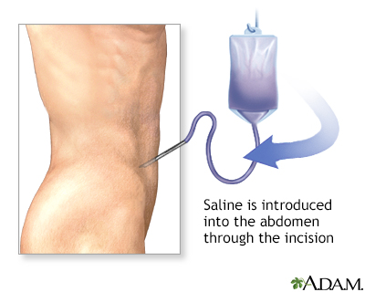 <strong>Procedure, part 1</strong><p>A catheter is introduced through the incision into the abdomen. Saline is infused into the abdomen through the catheter, and then removed. If blood is present in the saline after removal, it is highly probable that there is a serious intra-abdominal injury.</p>