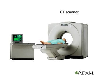 <strong>Procedure, part 2</strong><p>CT scans are also used to detect intra-abdominal injury in trauma patients and are a valuable adjunct to DPL. The combination of DPL and CT scan allows surgeons to minimize the incidence of unnecessary laparotomy in trauma patients.</p>