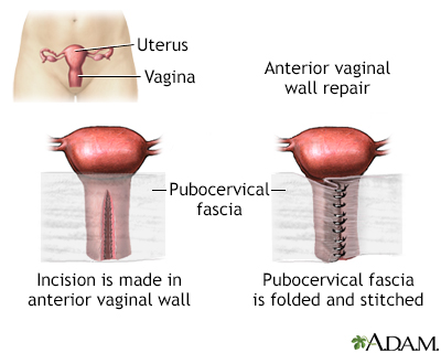 Anterior vaginal wall repair