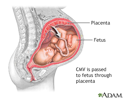 Congenital cytomegalovirus