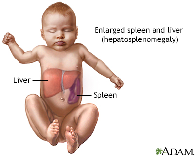 Hepatosplenomegaly