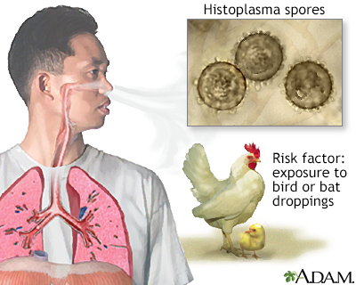 Acute histoplasmosis