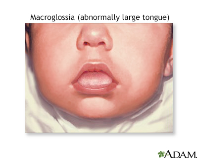 Macroglossia