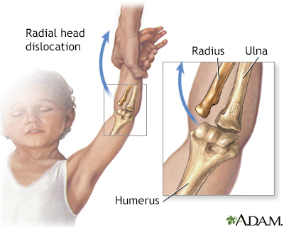 Radial head injury