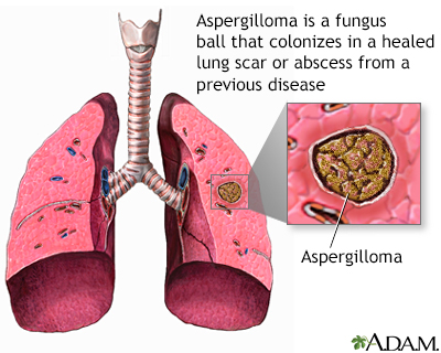 Aspergilloma