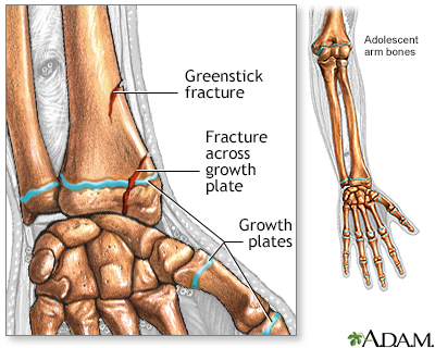 Fractures across a growth plate