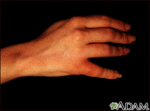 Staphylococcal lymphangitis