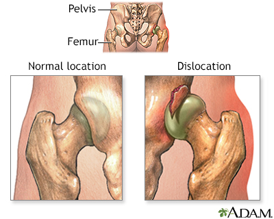 Dislocation of the hip