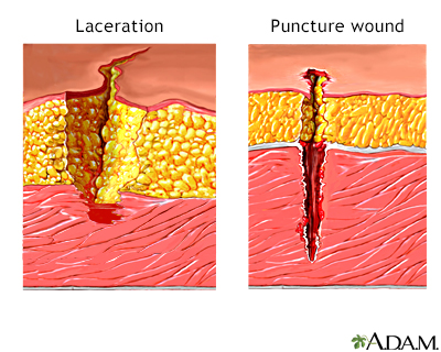 Laceration versus puncture wound