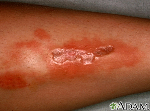 Necrobiosis lipoidica diabeticorum - leg