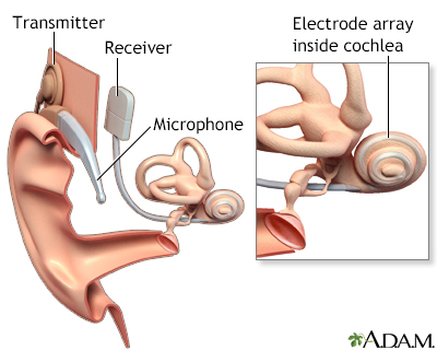 Cochlear implant