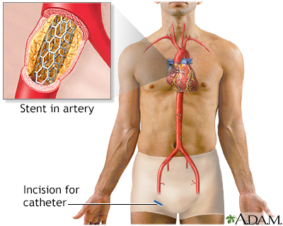 Coronary artery stent