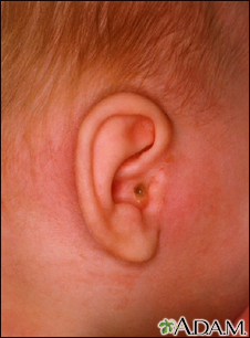 Mastoiditis - side view of head