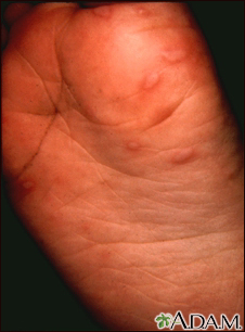 Hand, foot, and mouth disease on the foot