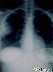 Aspergillosis - chest X-ray