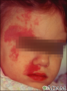 Port wine stain on a child's face