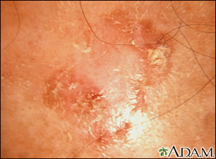 Actinic keratosis - close-up