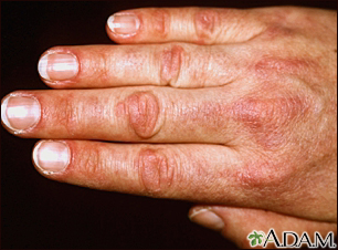 Dermatomyositis - Gottron papule