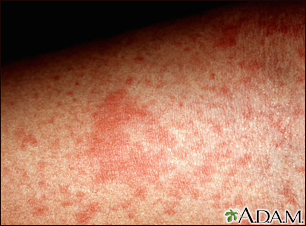 Eczema, atopic - close-up