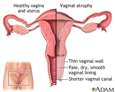 Vaginal atrophy